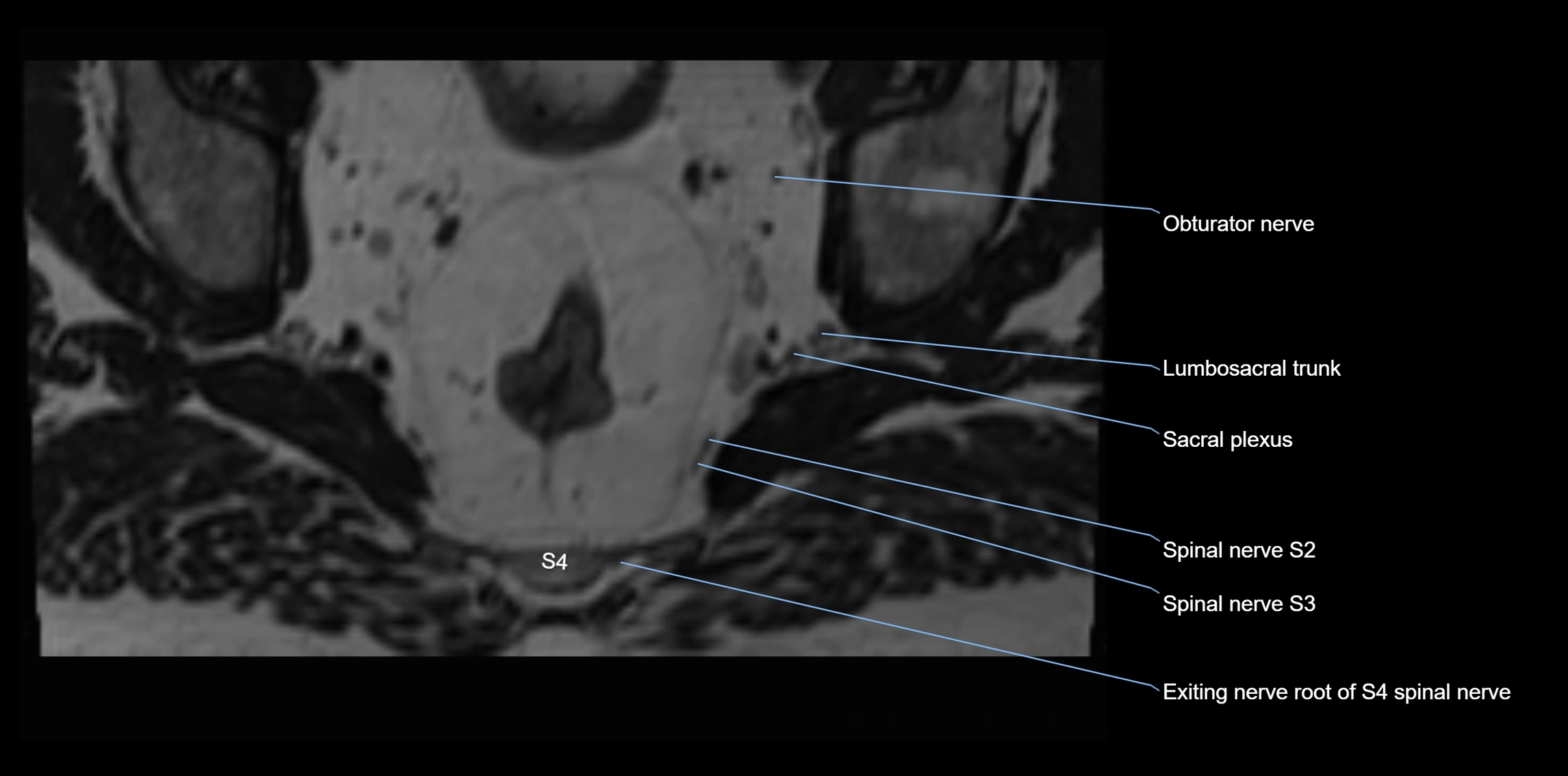 MR lumbosacral plexus axial cross sectional anatomy 3T  radiology  image-img-1008001-00104.webp